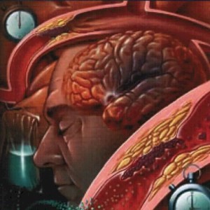 Agyv�rz�s - stroke